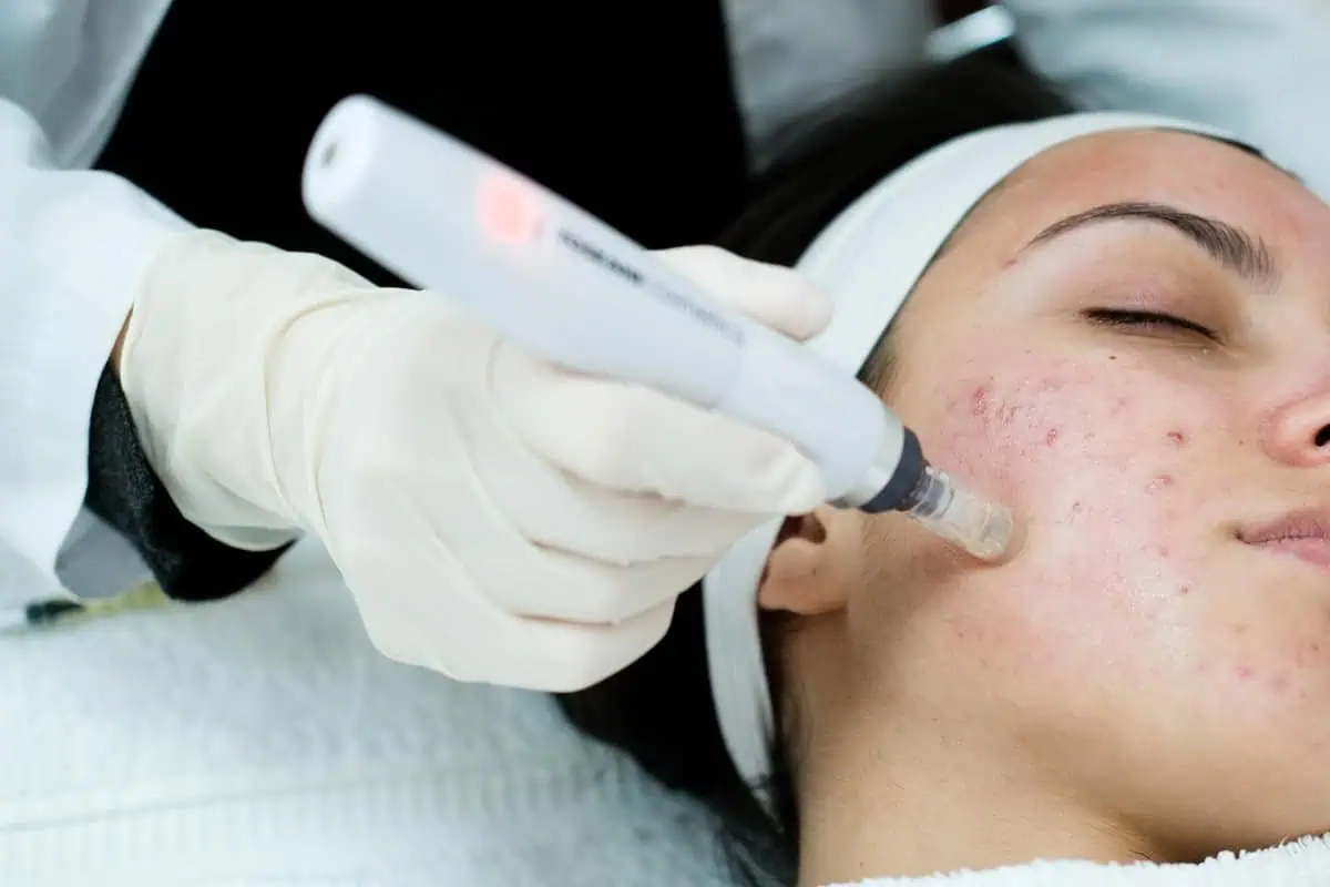 acne scars, acne scar treatment, acne scar laser treatment, acne scar treatments, acne scar laser treatment, acne scar removal,