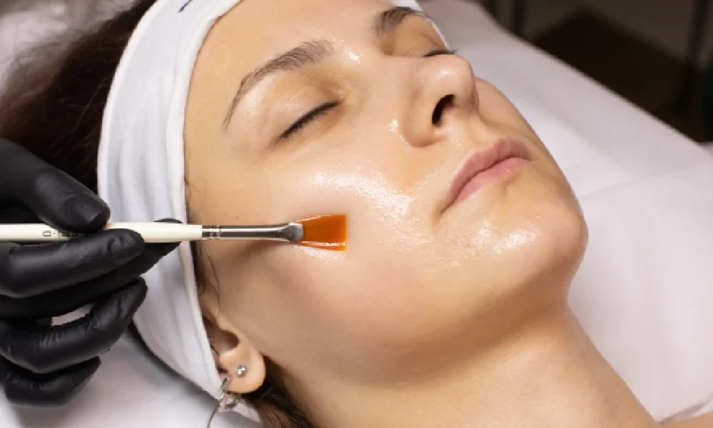 A woman receiving a VI Peels in O'Neill, NE