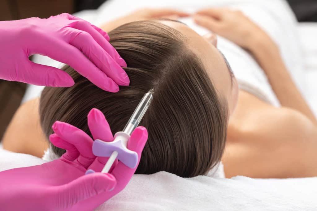 The Use Of Microneedling For Hair Regeneration
