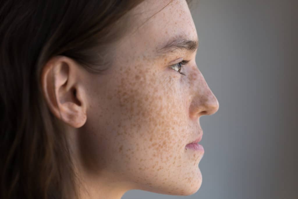 How Do I Get Rid of Brown Spots or Dark Spots?