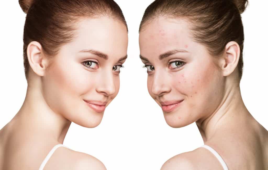 What are the Different Types of Acne?