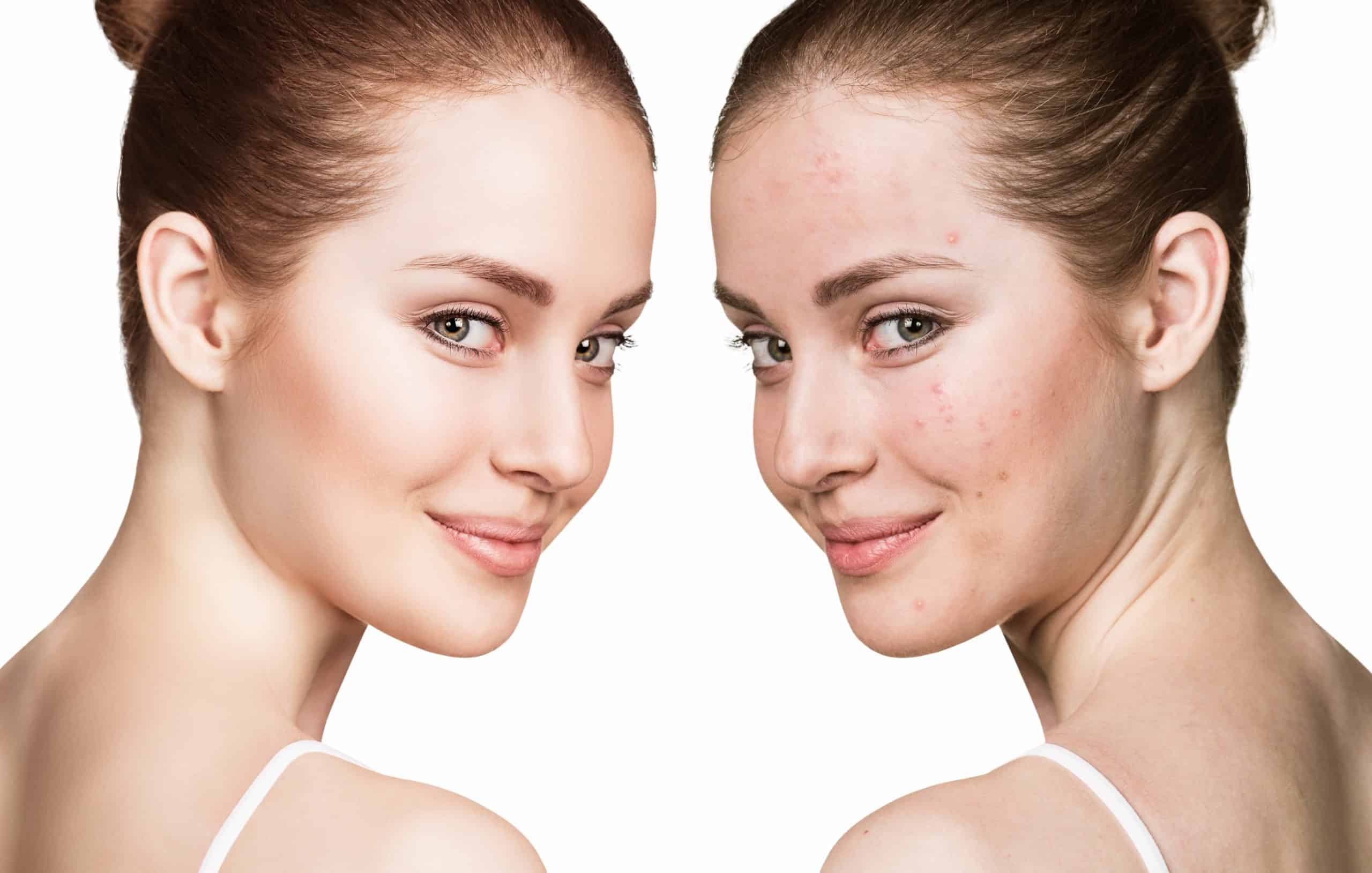 what-are-the-different-types-of-acne-taylered-aesthetics