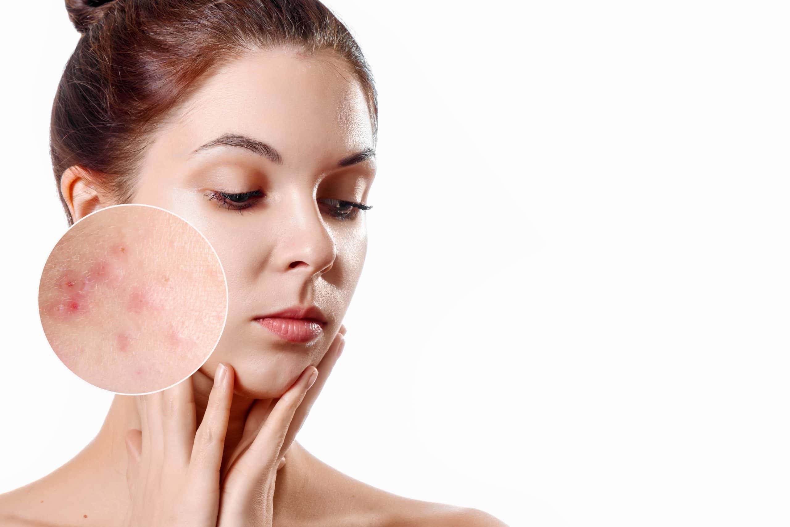 What is the Best Treatment for Acne Scars