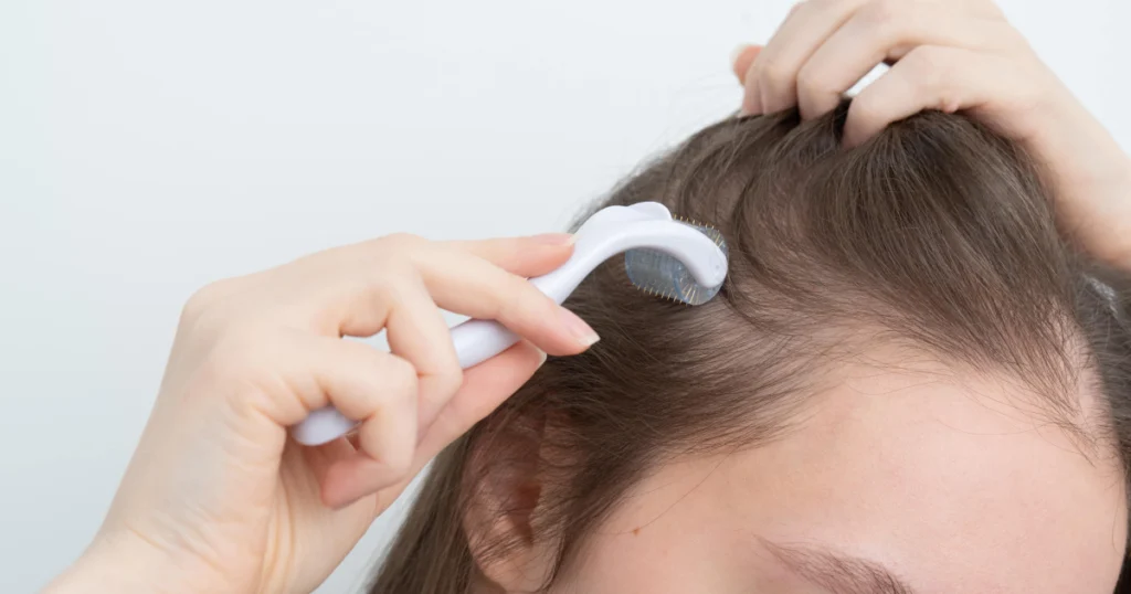 Hair regeneration treatment with derma roller on scalp by Taylered Aesthetics in O'Neill, NE