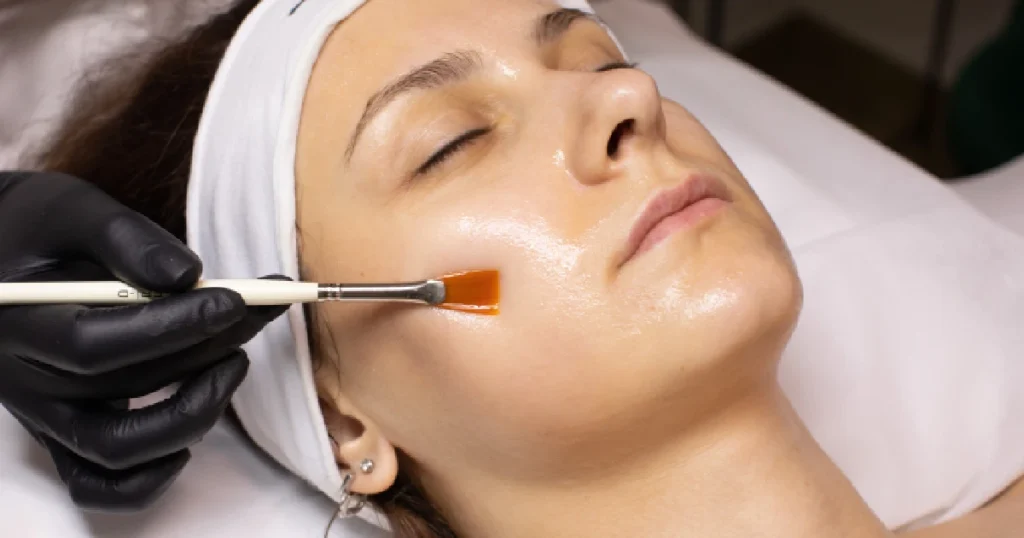 A woman receiving a VI Peels in O'Neill, NE