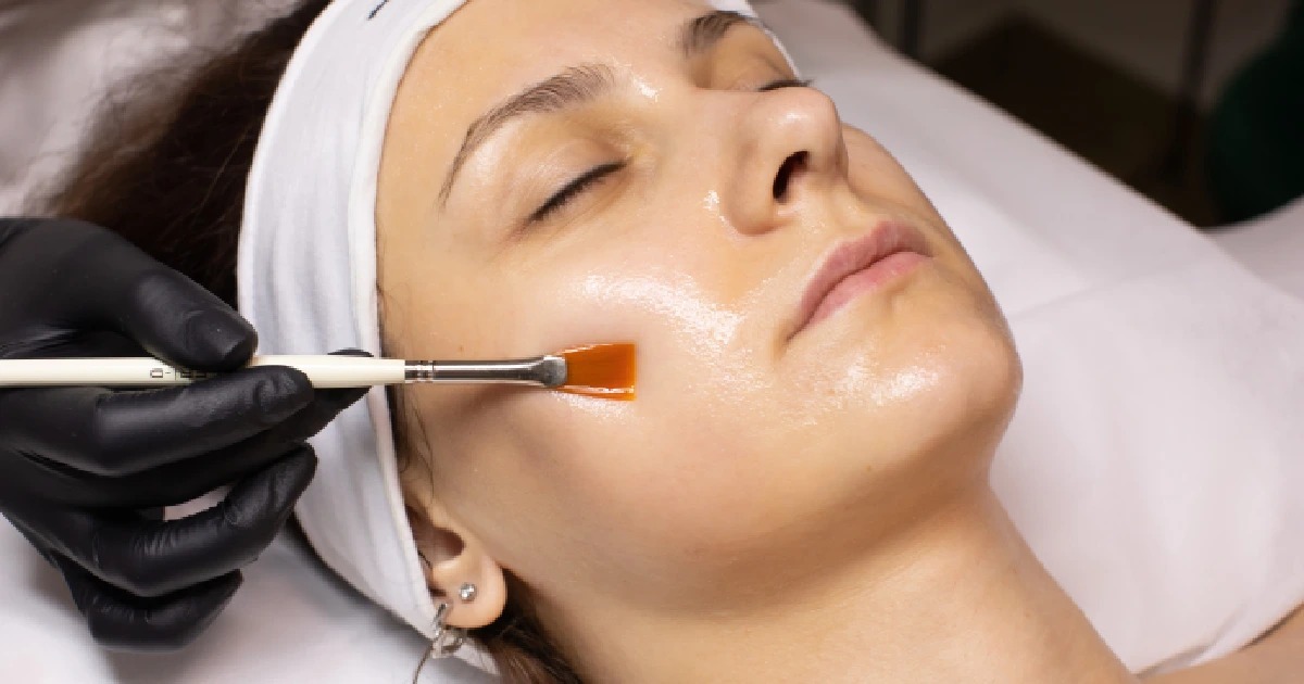 A woman receiving a VI Peels in O'Neill, NE