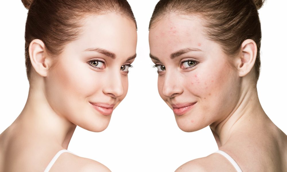 What are the Different Types of Acne?